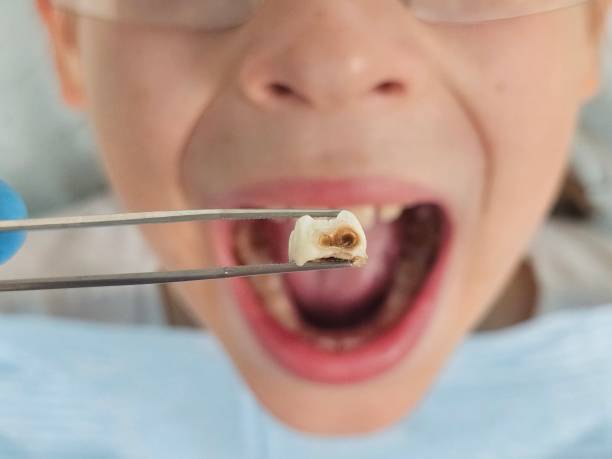 Best Emergency Dental Care for Broken or Chipped Teeth in Wabasso Beach, FL